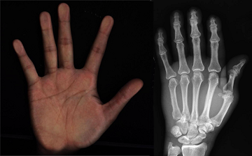 X-Ray Image of Hands